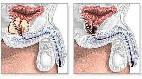 Vor und nach der Behandlung chronischer Prostatitis chirurgisch