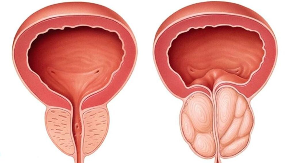 normale und vergrößerte Prostata