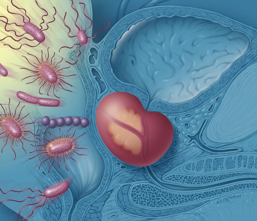 Prostatitis bei Männern