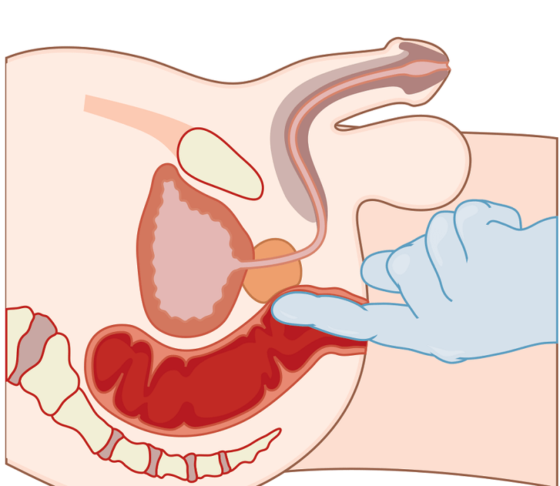 Prostata -Massage mit Prostatitis