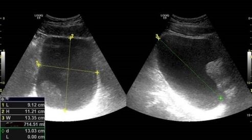 Anzeichen einer Prostatitis für Ultraschall