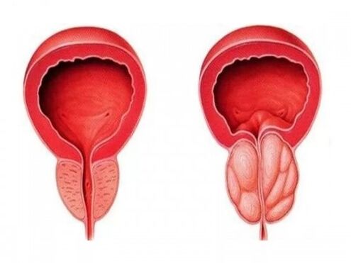 Gesunde und entzündete Prostata
