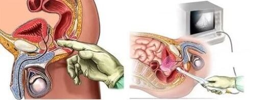 Instrumentaldiagnose von Prostatitis